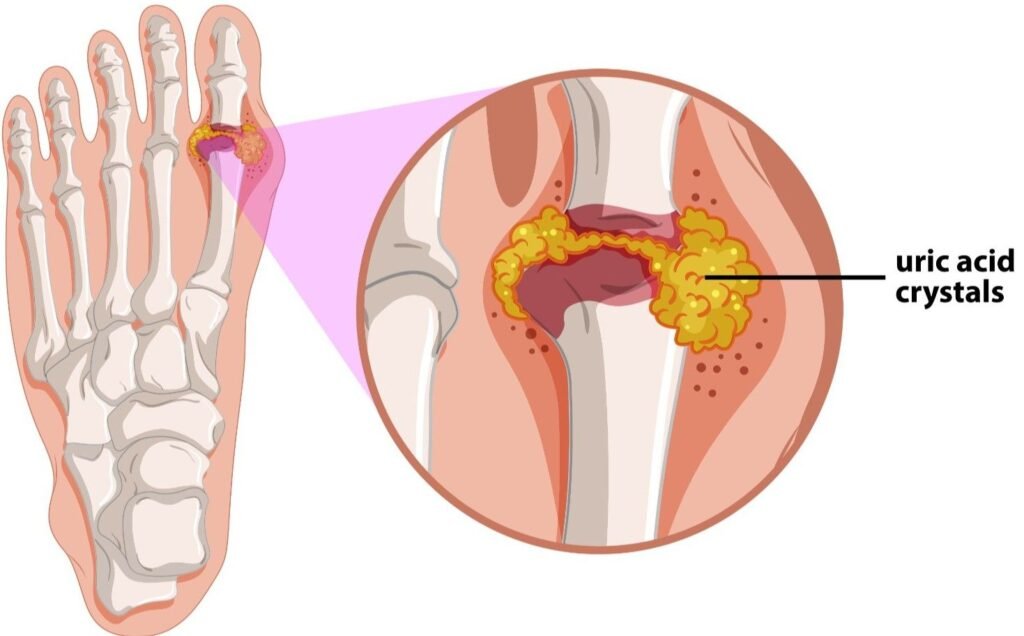 Best Gout Treatment in Gurugram