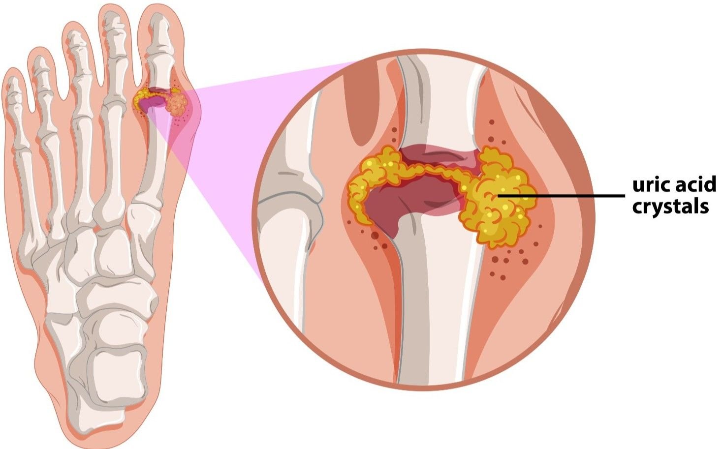 Best Gout Treatment in Gurugram