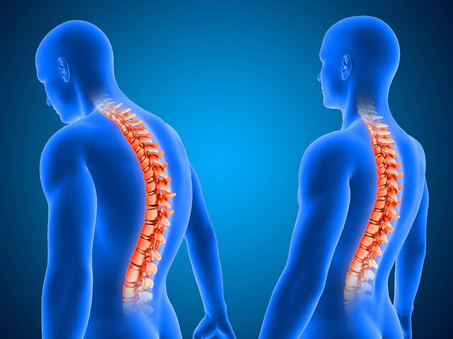 Best Ankylosing Spondylitis Treatment in Gurugram