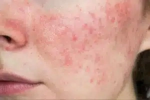 Best Systemic Lupus Erythematosus Treatment in Gurgaon