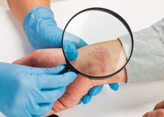 Best Scleroderma Specialist in Gurugram