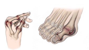 Best Rheumatoid Arthritis in Gurugram