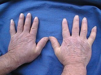 Best Scleroderma Doctor in Gurugram