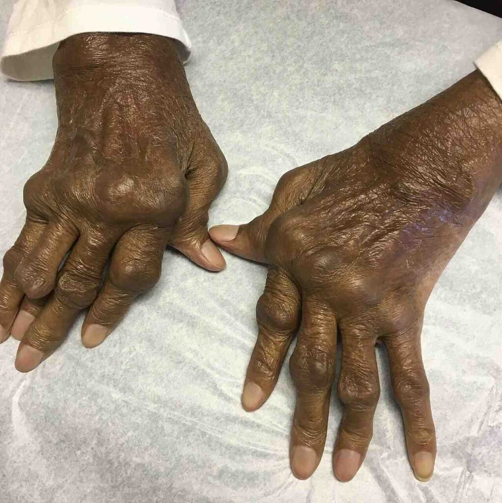 Rheumatology in Gurgaon