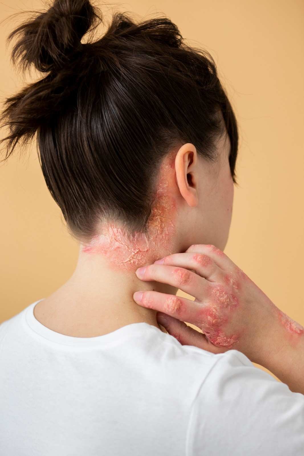 Systemic Lupus Erythematosus in Gurugram