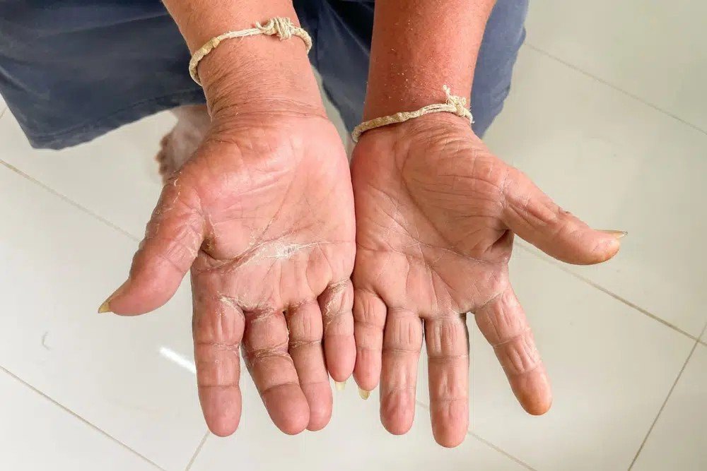 Scleroderma Treatment in Gurgaon