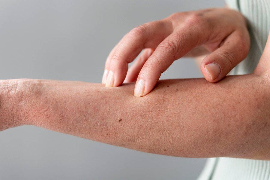 Close-up of a person examining tight skin on the forearm, illustrating symptoms associated with scleroderma and autoimmune skin conditions.