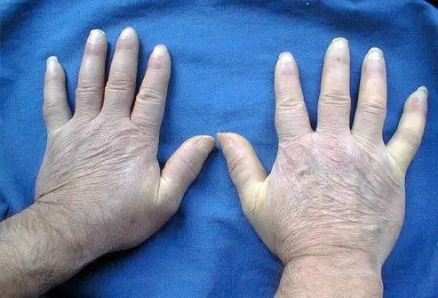 Scleroderma Treatment in Gurgaon
